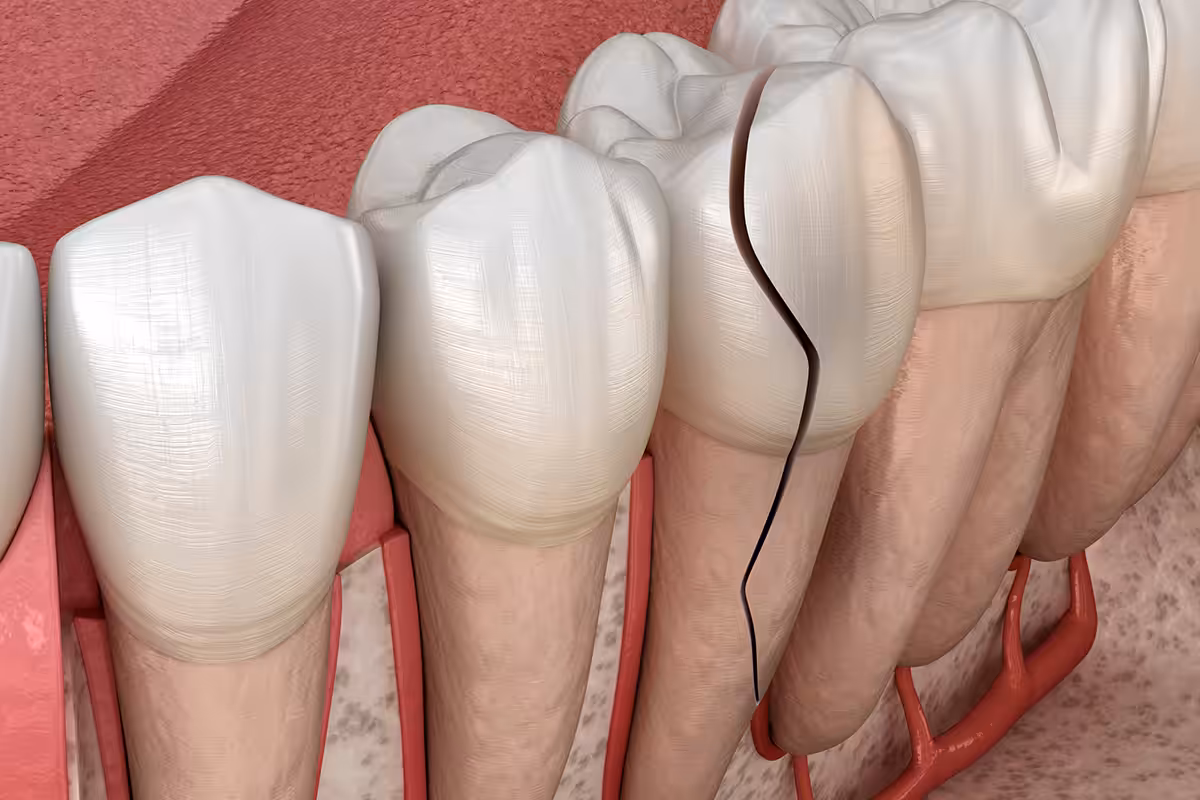 Best treatment options for vertical root fractures in adults blog