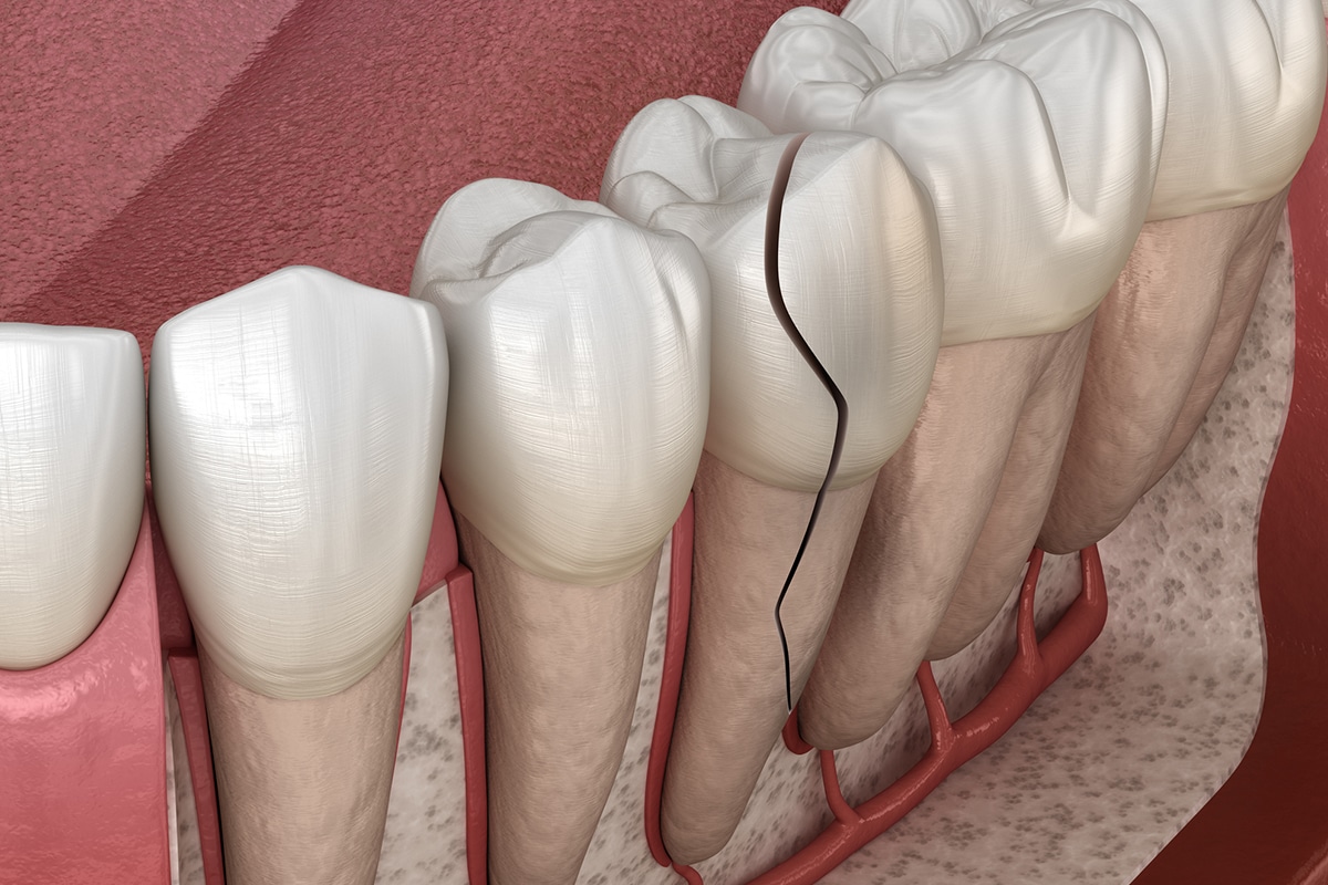 Can A Cracked Tooth Heal On Its Own Blog