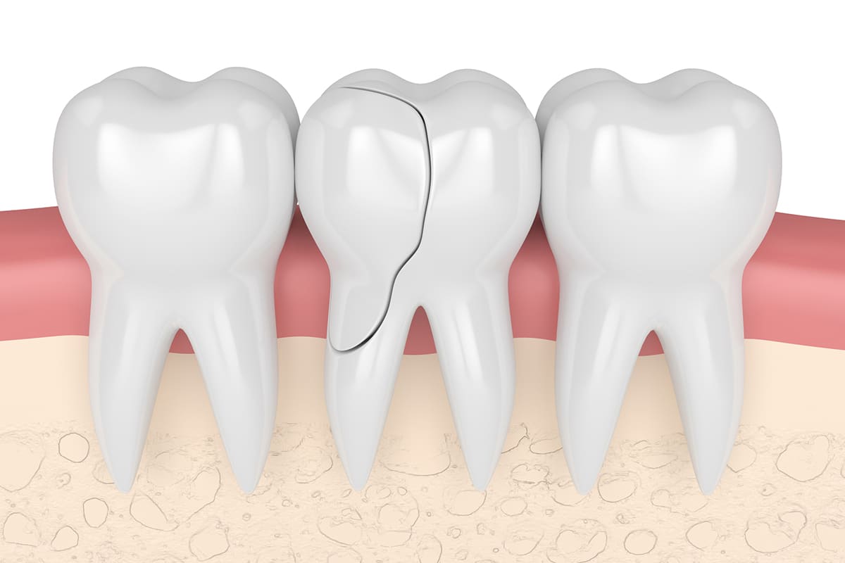 What Happens If You Ignore A Cracked Tooth Blog